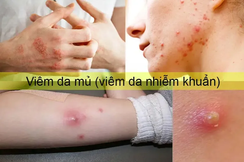Atlas 79+ hình ảnh Viêm da mủ, từ nhẹ đến nặng 3