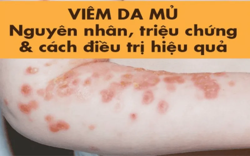 Atlas 79+ hình ảnh Viêm da mủ, từ nhẹ đến nặng 27