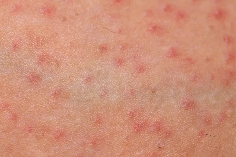 Bạn có đang bị viêm nang lông? 65+ ảnh để biết chính xác 12