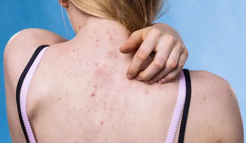 Bạn có đang bị viêm nang lông? 65+ ảnh để biết chính xác 13