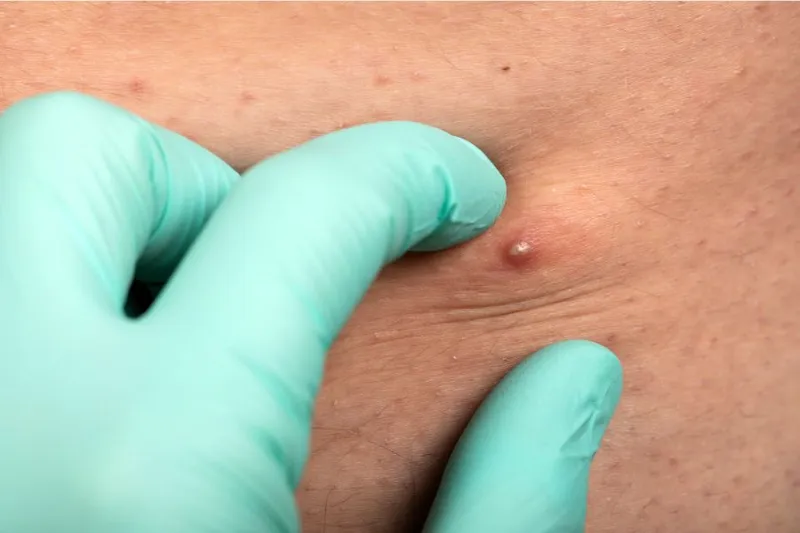 Bạn có đang bị viêm nang lông? 65+ ảnh để biết chính xác 23