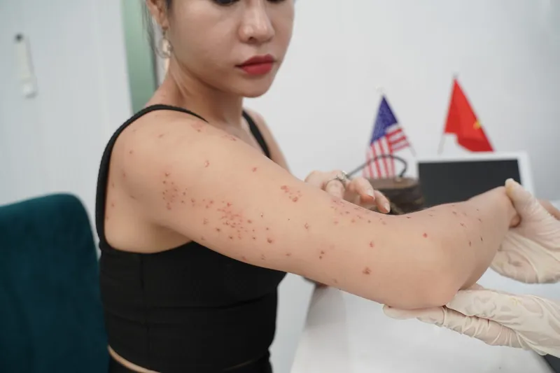 Bạn có đang bị viêm nang lông? 65+ ảnh để biết chính xác 26