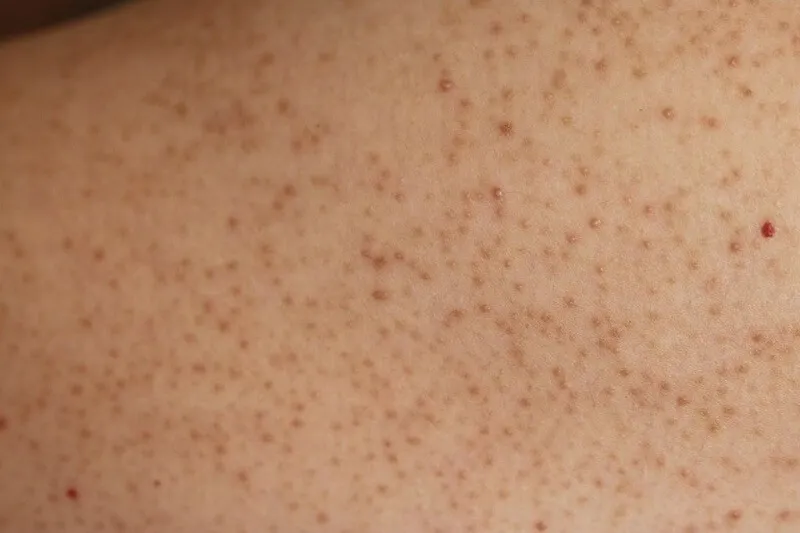 Bạn có đang bị viêm nang lông? 65+ ảnh để biết chính xác 28