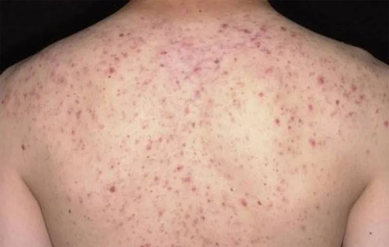 Bạn có đang bị viêm nang lông? 65+ ảnh để biết chính xác 30
