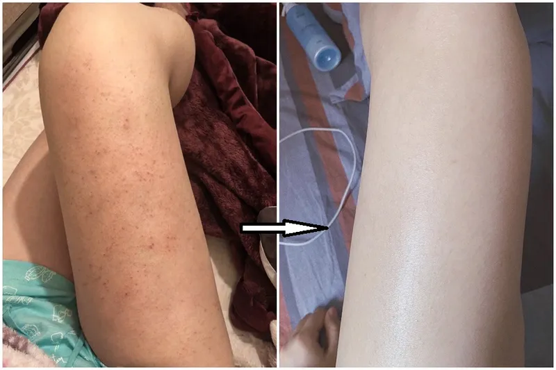 Bạn có đang bị viêm nang lông? 65+ ảnh để biết chính xác 1