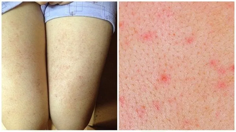 Bạn có đang bị viêm nang lông? 65+ ảnh để biết chính xác 14