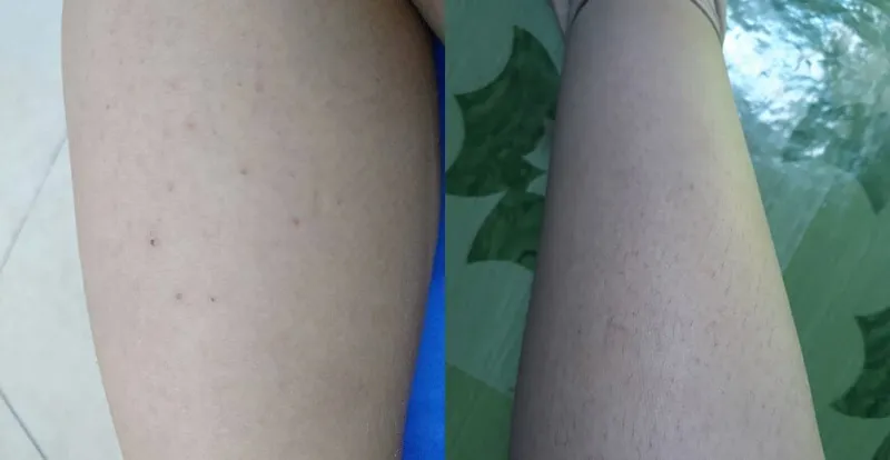 Bạn có đang bị viêm nang lông? 65+ ảnh để biết chính xác 2