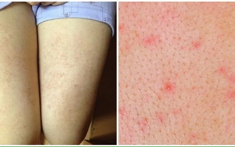  Bạn có đang bị viêm nang lông? 65+ ảnh để biết chính xác 3