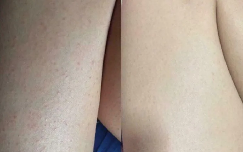 Bạn có đang bị viêm nang lông? 65+ ảnh để biết chính xác 4