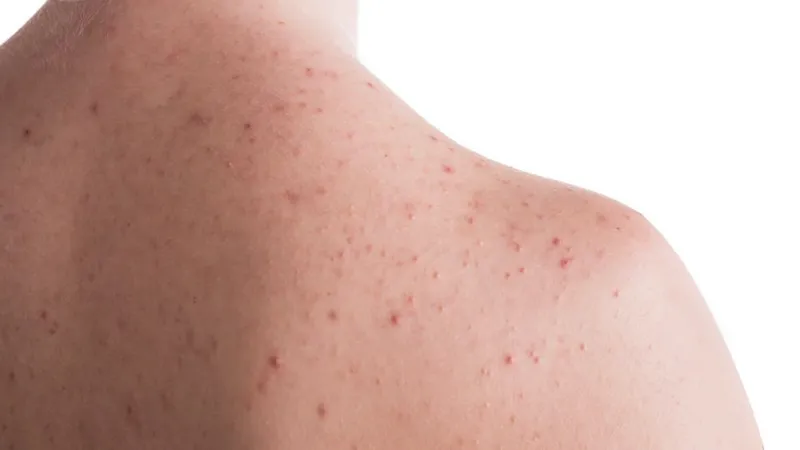 Bạn có đang bị viêm nang lông? 65+ ảnh để biết chính xác 5