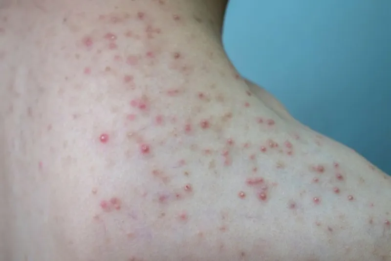 Bạn có đang bị viêm nang lông? 65+ ảnh để biết chính xác 8