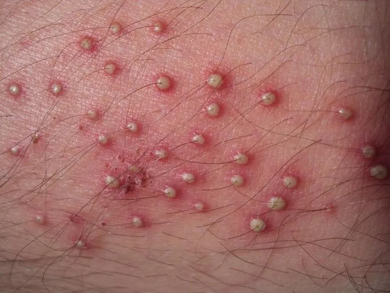 Bạn có đang bị viêm nang lông? 65+ ảnh để biết chính xác 15