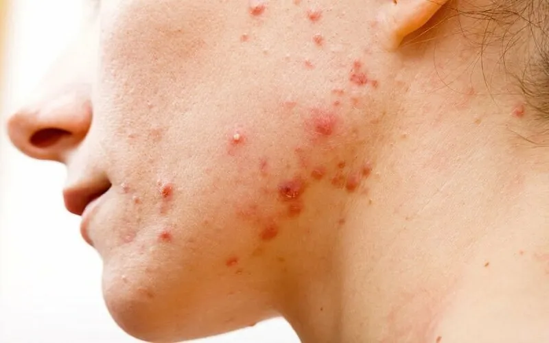 Bạn có đang bị viêm nang lông? 65+ ảnh để biết chính xác 16