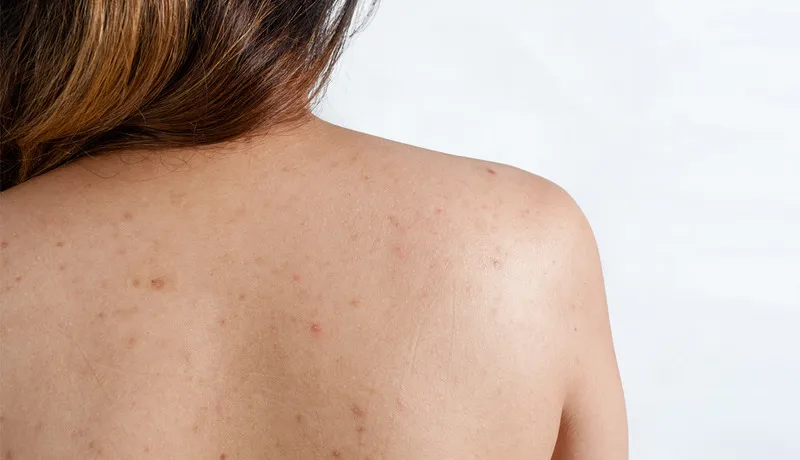 Bạn có đang bị viêm nang lông? 65+ ảnh để biết chính xác 17
