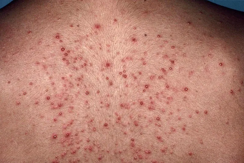Bạn có đang bị viêm nang lông? 65+ ảnh để biết chính xác 18
