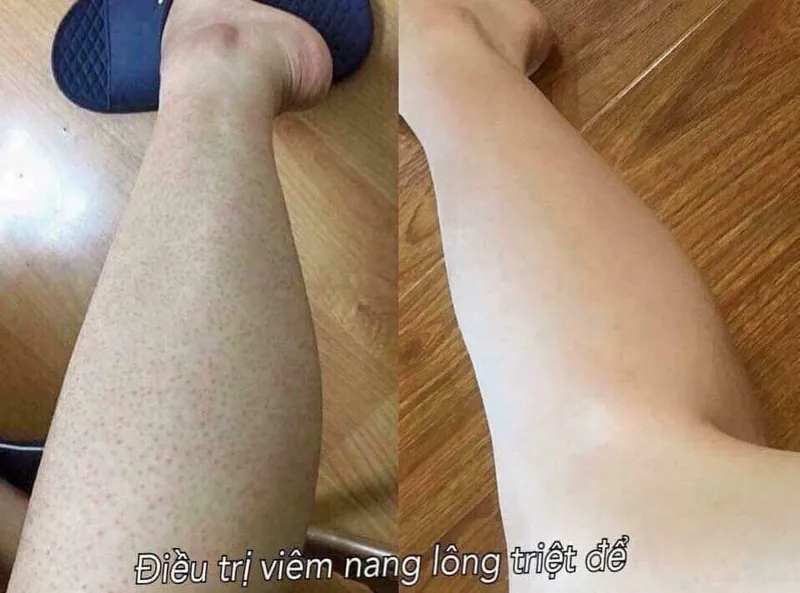 Bạn có đang bị viêm nang lông? 65+ ảnh để biết chính xác 21