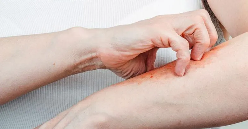 Bệnh ghẻ 95+ hình ảnh thực tế và những điều để phòng tránh 1