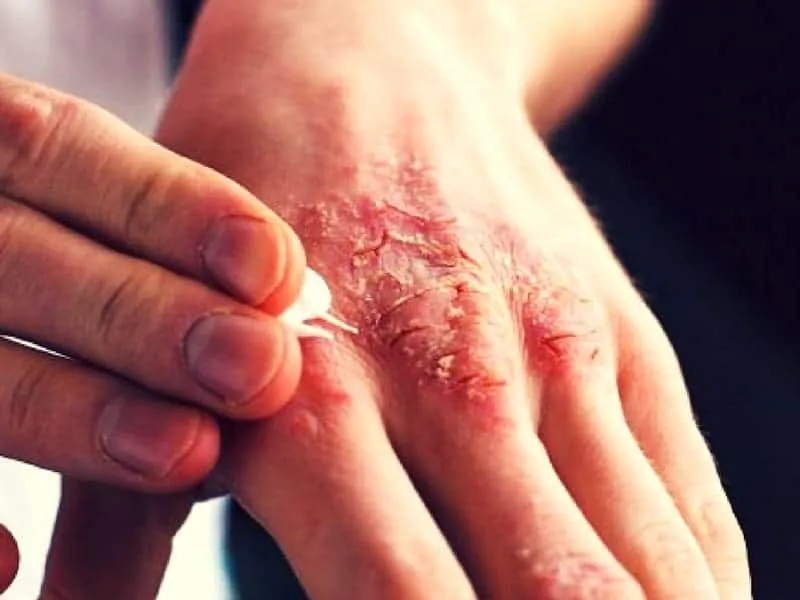 Bệnh ghẻ 95+ hình ảnh thực tế và những điều để phòng tránh 11