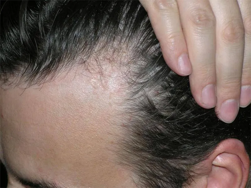 Bệnh ghẻ 95+ hình ảnh thực tế và những điều để phòng tránh 12
