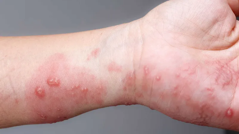 Bệnh ghẻ 95+ hình ảnh thực tế và những điều để phòng tránh 19