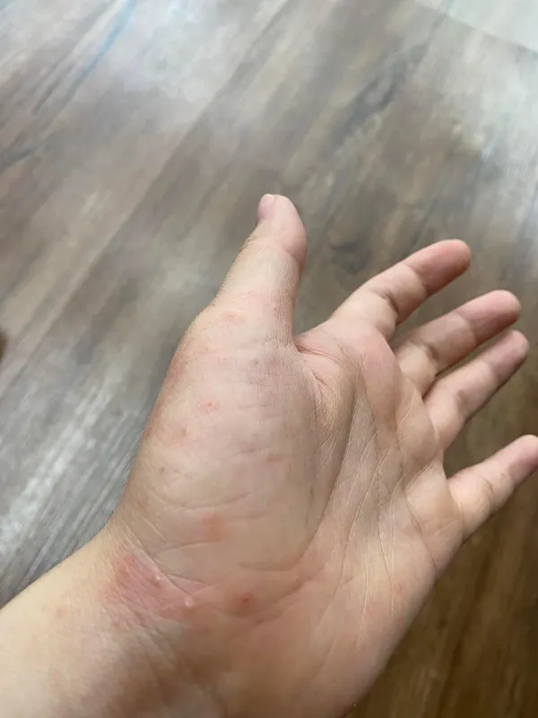 Bệnh ghẻ 95+ hình ảnh thực tế và những điều để phòng tránh 20