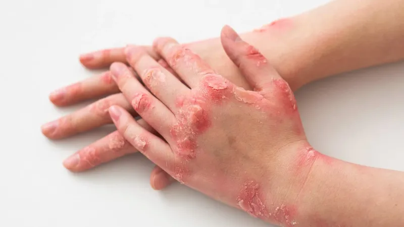 Bệnh ghẻ 95+ hình ảnh thực tế và những điều để phòng tránh 21