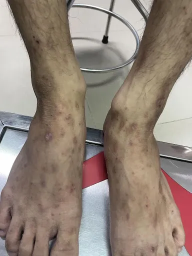 Bệnh ghẻ 95+ hình ảnh thực tế và những điều để phòng tránh 23
