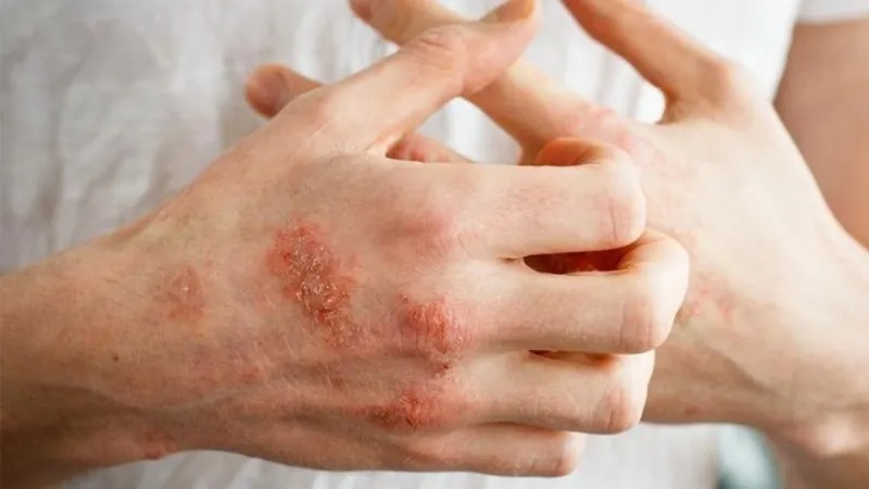 Bệnh ghẻ 95+ hình ảnh thực tế và những điều để phòng tránh 27