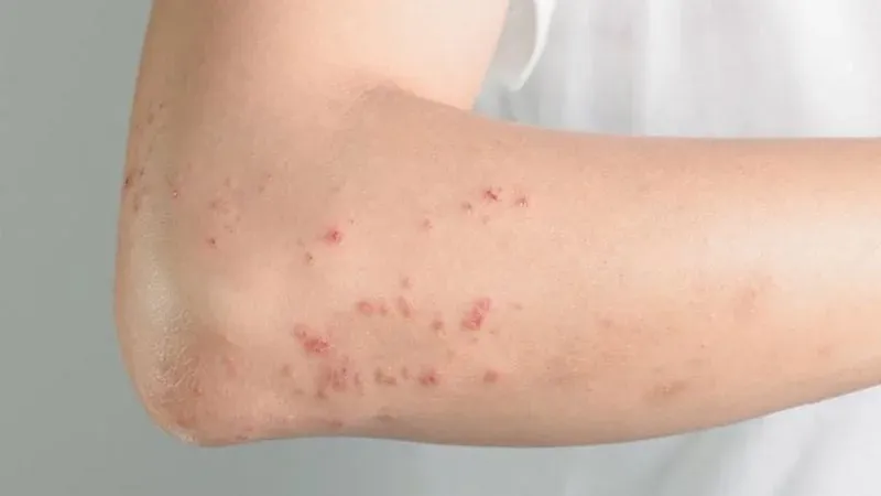 Bệnh ghẻ 95+ hình ảnh thực tế và những điều để phòng tránh 28