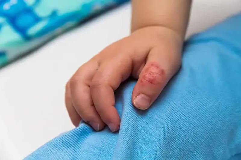 Bệnh ghẻ 95+ hình ảnh thực tế và những điều để phòng tránh 7