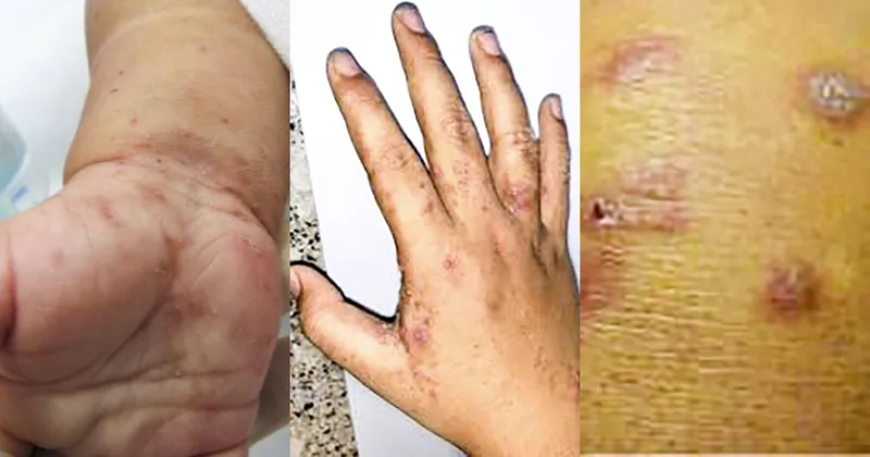  Bệnh ghẻ 95+ hình ảnh thực tế và những điều để phòng tránh 8