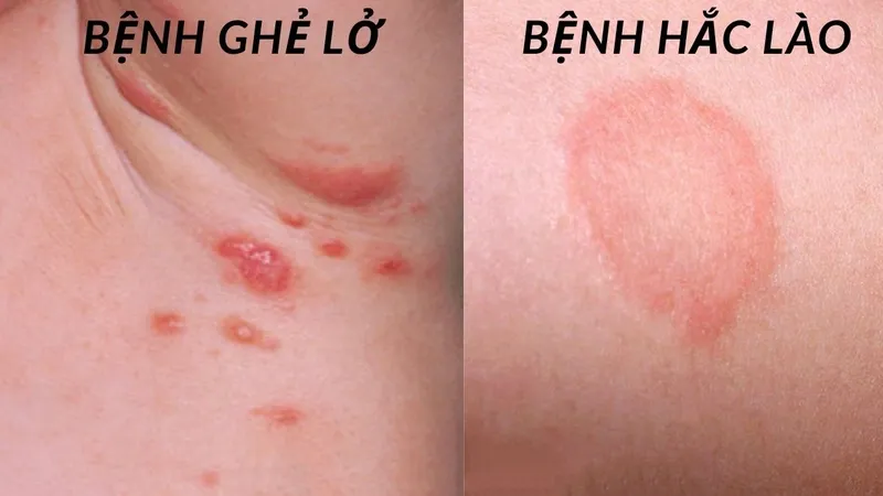Bệnh ghẻ 95+ hình ảnh thực tế và những điều để phòng tránh 10