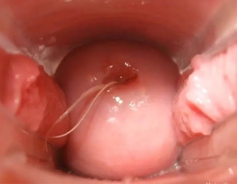 Cảnh báo, nhận biết viêm âm đạo do vi khuẩn qua hình ảnh 1