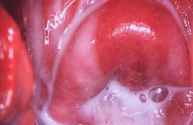 Cảnh báo, nhận biết viêm âm đạo do vi khuẩn qua hình ảnh 2