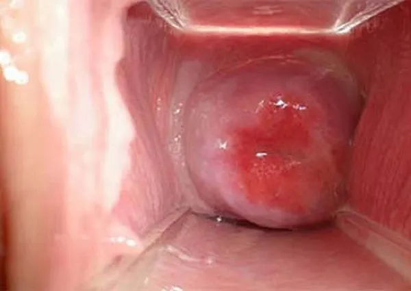 Cảnh báo, nhận biết viêm âm đạo do vi khuẩn qua hình ảnh 12