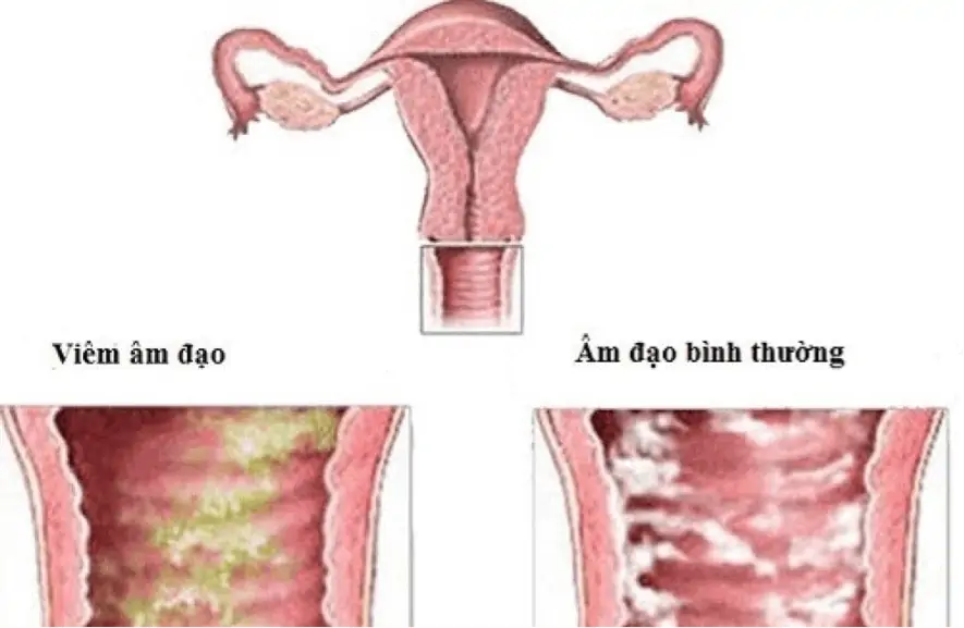  Cảnh báo, nhận biết viêm âm đạo do vi khuẩn qua hình ảnh 13