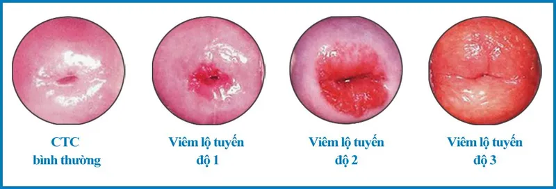 Cảnh báo, nhận biết viêm âm đạo do vi khuẩn qua hình ảnh 14
