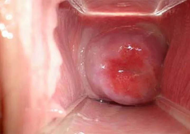 Cảnh báo, nhận biết viêm âm đạo do vi khuẩn qua hình ảnh 15