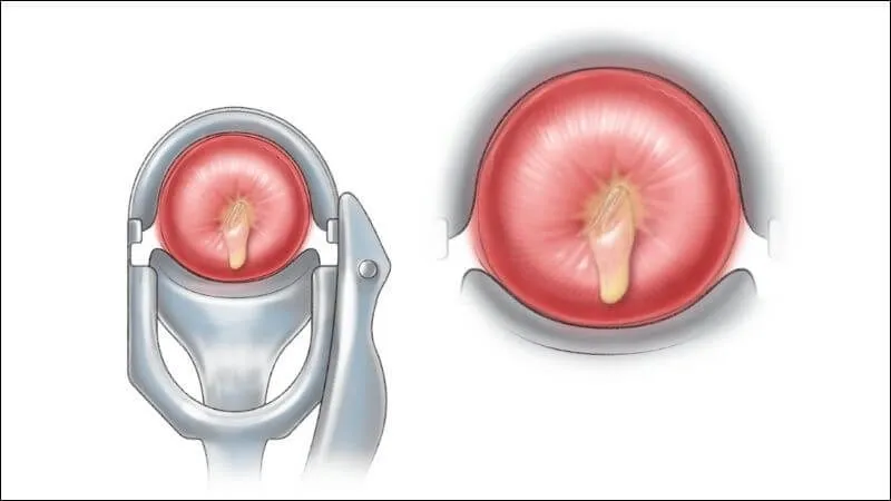 Cảnh báo, nhận biết viêm âm đạo do vi khuẩn qua hình ảnh 17