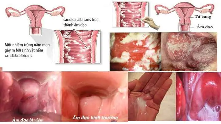 Cảnh báo, nhận biết viêm âm đạo do vi khuẩn qua hình ảnh 3