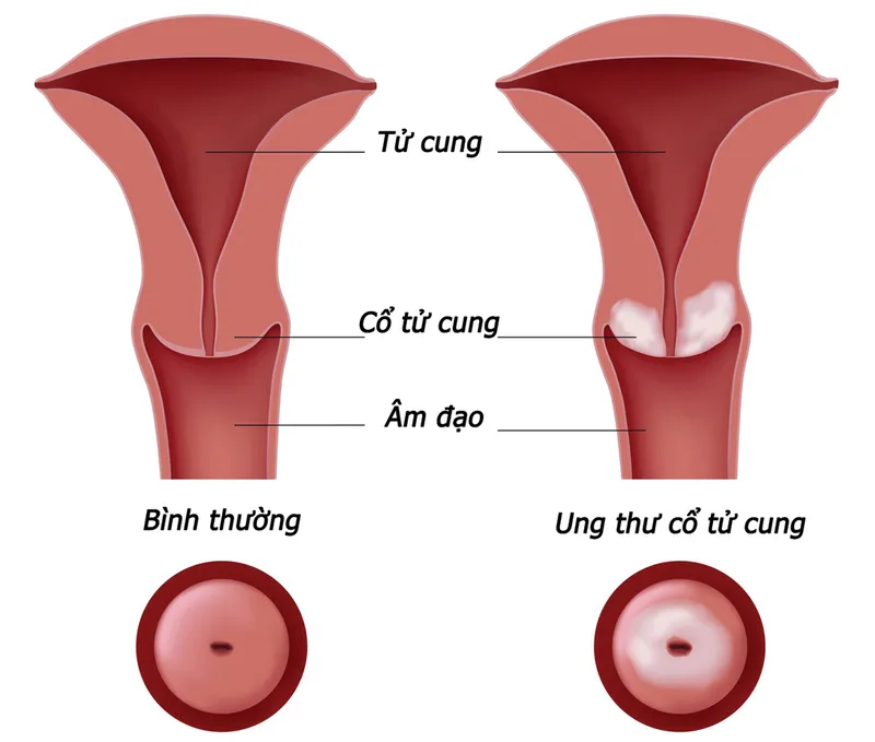 Cảnh báo, nhận biết viêm âm đạo do vi khuẩn qua hình ảnh 21