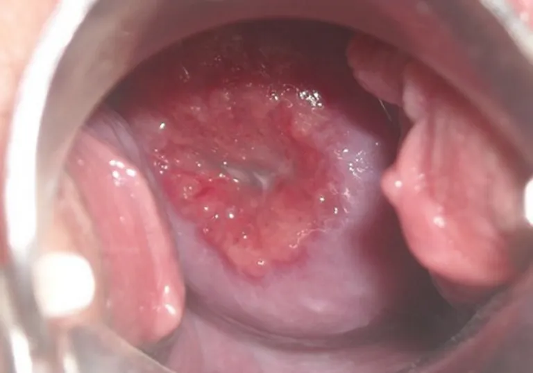 Cảnh báo, nhận biết viêm âm đạo do vi khuẩn qua hình ảnh 22
