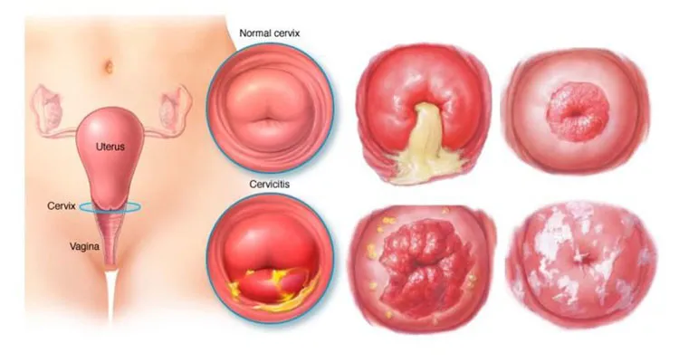 Cảnh báo, nhận biết viêm âm đạo do vi khuẩn qua hình ảnh 4