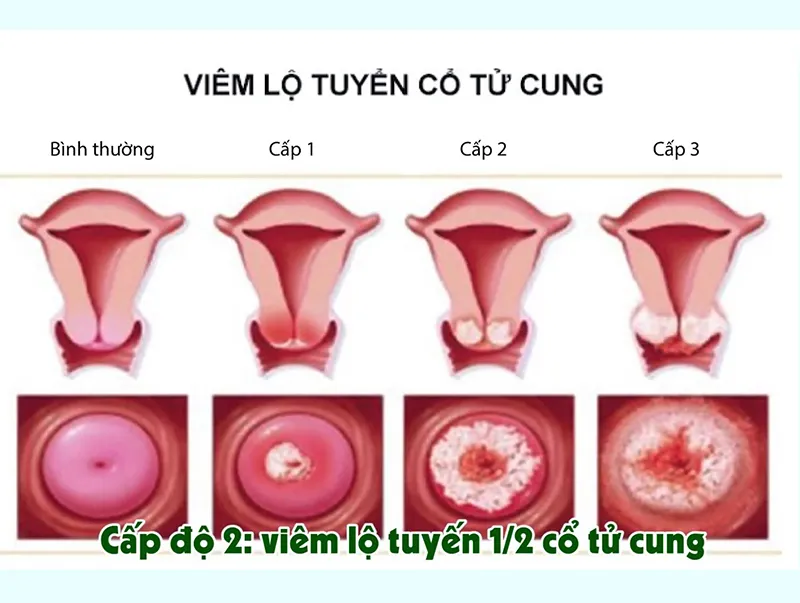 Cảnh báo, nhận biết viêm âm đạo do vi khuẩn qua hình ảnh 6