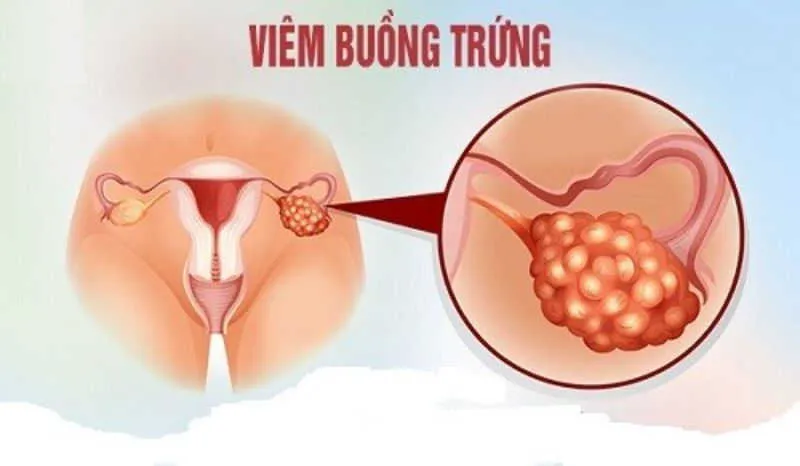 Cảnh báo, nhận biết viêm âm đạo do vi khuẩn qua hình ảnh 7