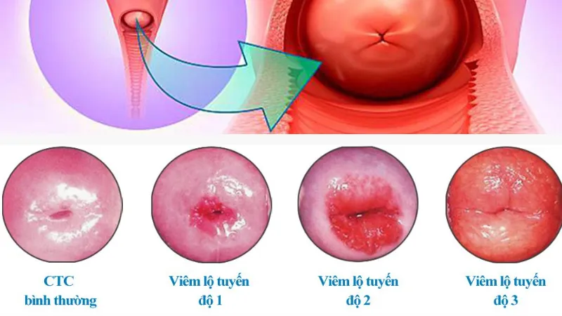 Cảnh báo, nhận biết viêm âm đạo do vi khuẩn qua hình ảnh 8
