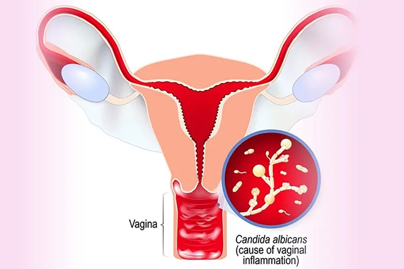 Cảnh báo, nhận biết viêm âm đạo do vi khuẩn qua hình ảnh 10