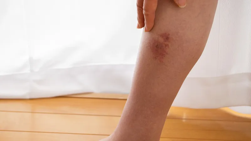 Thư viện hình ảnh Viêm mô tế bào, cập nhật mới nhất 2