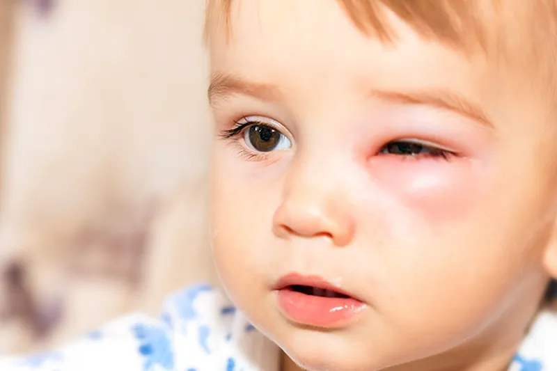 Thư viện hình ảnh Viêm mô tế bào, cập nhật mới nhất 18