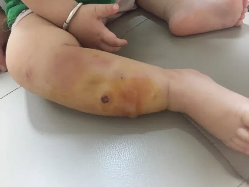 Thư viện hình ảnh Viêm mô tế bào, cập nhật mới nhất 19